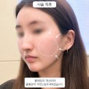 대박땅콩 | 신사역 잠원동피부과 티타늄리프팅 '신사동웨딩관리' 땅콩형 솔직후기 (효과, 붓기, 기간)