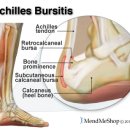 아킬레스 점액낭염으로 보는 만성염증에 대한 사고의 확장!! - 정리중... 이미지