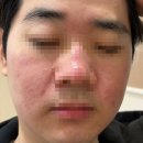 영피부샵 | [배곧 피부샵] 영뷰티 여드름 필링 후기