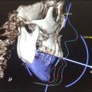 한길의료기 | 네비게이션 양악 완전히 달라진 방법