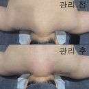 전주피부관리 한울에스테틱에서 후면 제대로 풀었어요