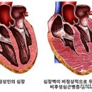 &#34;&#39;비후성 심근증&#39; 환자, 심장 수축 정상이어도 예후 나쁠 수 있어&#34; 이미지