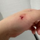새살로외과의원 | 칼에 베인 상처 봉합 후기｜1년 지난 지금 흉터는?