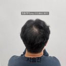 다해드립니다 | 부산 사하구 30대 남자 정수리 두피문신 후기(+부작용)