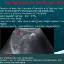 Hemangioma of the Spleen (60/F) 이미지