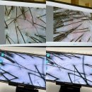 범계역 에스테틱 웰스칼프 두피&amp;피부 두피스케일링 플라즈마 LDM 관리 솔직 후기