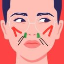 브이락소프트 | 강남역피부과 팔자주름 짧은실리프팅 민트쁘띠+잼버실+채움필러 솔직후기(비포&amp;에프터)