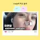 미용사자격증 | 대전 실면도 미온담에서 쥐젖제거 후기