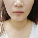 통증없이 리프팅 피아모 리프팅 강남 뉴케이의원 솔직후기