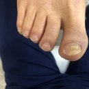 반송약국 | 동탄 발톱무좀 관리 꼼꼼한 레푸스동탄반송점