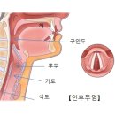 인후두염(Laryngopharyngitis) 이미지