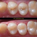 프라임치과기공소 | 이수역 치과 10년 넘게 이어온 진심, 오늘하루치과가 말하는 자연치 살리는 치료