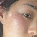 세종성형외과의원 | 해외교민 한국방문할때 무조건 할 것: 피부과 - 리쥬란, 울쎄라, 레이저 가격 &amp; 병원 후기