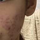 새로나병원 | 여드름 피부 이소티논 약 후기 [부작용, 효과 시기, 주의할 점]+내돈내산!