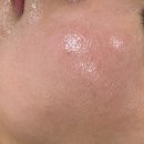 초이스메디칼 | 구래역 피부관리 추천｜[초이스뷰티] 모공·수분·편평사마귀 관리 솔직 후기