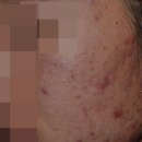 리체프라자 | 분당여드름피부과 한의원 병변 유형 확인하여