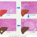 B형 간염 용어 이미지