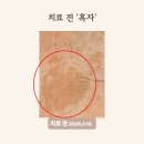 1064 | 수원 흑자 제거 후기, 60대 흑자 치료