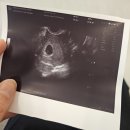 새봄산부인과의원 | (임신5주차) 부산 박은선 산부인과의원에서 아기집&amp;난황 확인한 후기💕