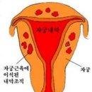 자궁내막증2(골반통,생리통) 이미지