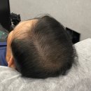 헤드샷스칼프본점 | 헤드샷스칼프 분당본점 : 아빠 정수리 두피커버 후기 ♩ 분당 두피커버 내돈내산 효도
