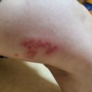 대상포진 이미지