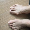 에버브라운 | 특허등록 무지외반증교정기 에버바디 착용후기