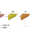 간경화 초기 말기 및 (간경변, 간섬유화, 알콜성, 복수) 이미지