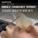 파리바게뜨중계두타빌점 | [중랑구 태릉입구 기미,잡티제거] 제로스팟으로 깔끔하게 없앤 후기!