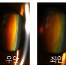 차안과 티스토리