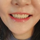 부산 | 부산 라미네이트 후기 - 파라다이스호텔 부산 <라스칼라> 신년회 모임 자신감 뿜뿜