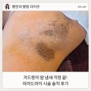 겨드랑이 액취증 땀 냄새 제거 미라드라이 후기