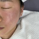 세포 | 종로피부과 줄기세포주사 후기