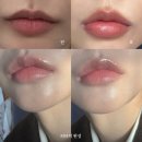 스케치멍 | 발산역 입술필러 리터치 전후, 리쥬비엘 자연스럽게 차오른 입술 (멍 붓기 후기)