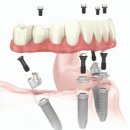전체임플란트비용/전체임플란트 비용/올온포 이미지
