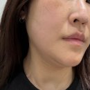 신사역피부과 써니리프팅 후기, 턱라인 집중한 이유