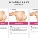 제이케이아름다운의원 | 가슴성형, 멘토스무스 보형물로 자연스럽게 완성하는 방법