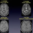 허리디스크 MRI보는 법. T1, T2, Sagittal view, axial view 이미지