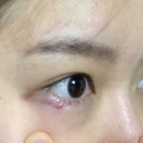 덕영약국 | 다래끼 수술 후기