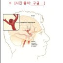 뇌동맥류 (cerebral aneurysm ) 이미지