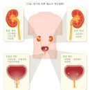 소변 이상 이미지