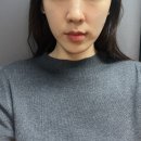 뷰티포레스트 | [중안부리프팅] 땅콩형얼굴 볼패임 시술 옆볼필러 말고 포레스트리프팅 찐 후기 팔자주름 인디언밴드