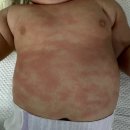 웰니스어린이병원 | 6개월 아기 장염 - 입원 후기(웰니스어린이병원)