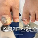 레푸스&네일몽