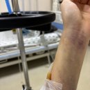 복대목욕탕 | [신장암 수술 후기] 수술 후 회복 기간, 일상 복귀까지 얼마나 걸렸을까?