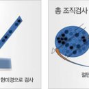 [갑상선조직검사] 총조직검사와 세침흡인 이미지