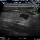 benign nodule 이미지