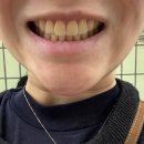 통영이플란트치과의원 | 강남역 치과 뉴엔치과 치아미백 솔직 후기