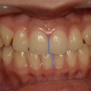 자모치과의원 | 성인 덧니, 안면비대칭 비발치 치아 교정 후기