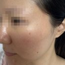 신부동편평사마귀 제거 한의원 드디어 다 아문 뒤 후기 씀!